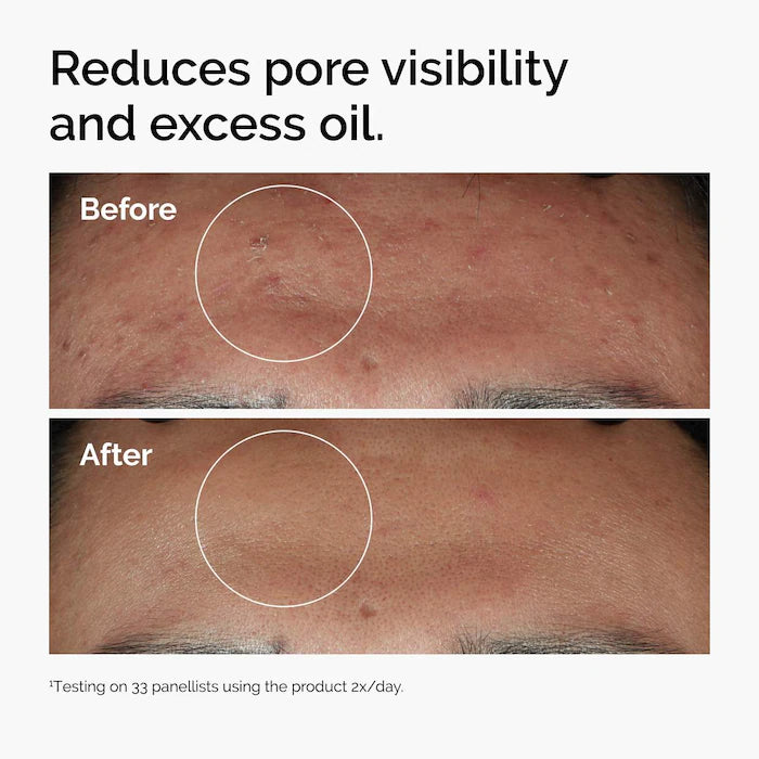 The Ordinary Niacinamide 10% + Zinc 1%  Serum for Oily Skin